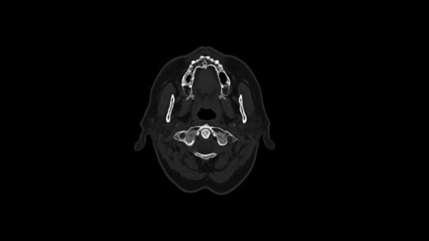 Computed medical tomography MRI scan of old female head. Top view — Stock Video