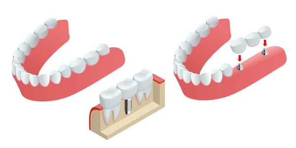 等距齿人体植入物。牙科的概念。人类的牙齿或假牙。3d 图分离上白色的现实矢量图 — 图库矢量图片