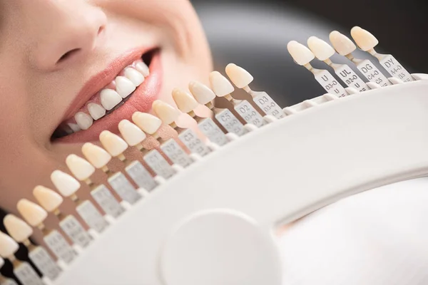 Dentes artificiais localizando perto dos lábios da mulher — Fotografia de Stock