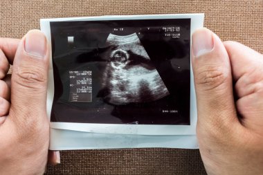 Ultrason sonogram doğmamış bir bebeğin fotoğrafı