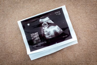 Ultrason sonogram doğmamış bir bebeğin fotoğrafı
