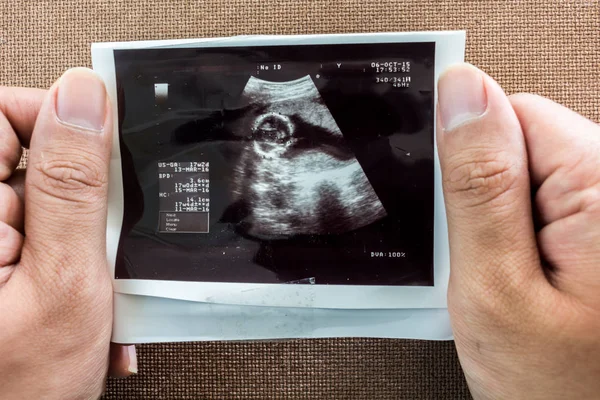 Foto de una ecografía de un bebé nonato — Foto de Stock