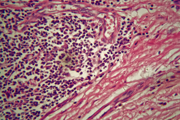 Stomach cancer cells under the microscope.
