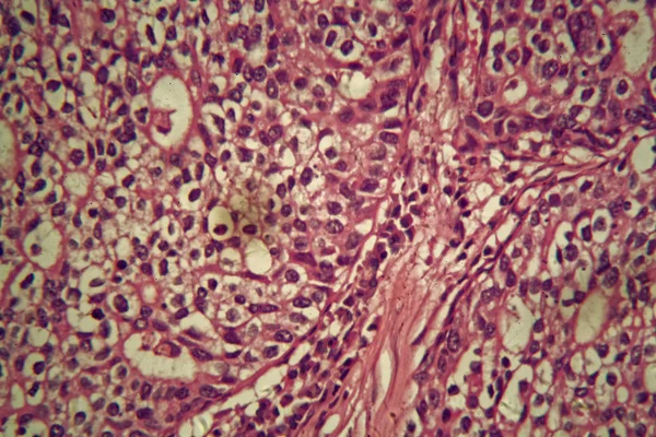 Stomach cancer cells under the microscope.