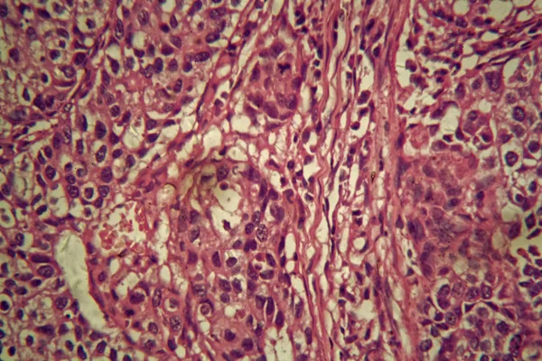 Células cancerígenas do estômago ao microscópio . — Fotografia de Stock