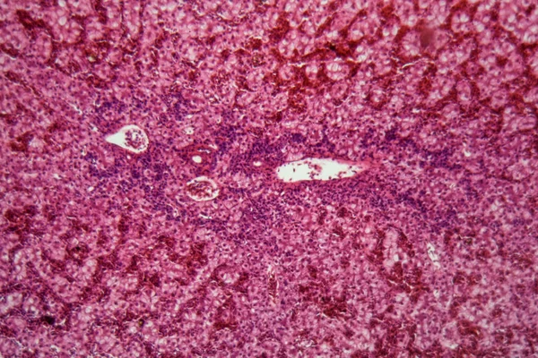 Cellules hépatiques humaines cancéreuses — Photo