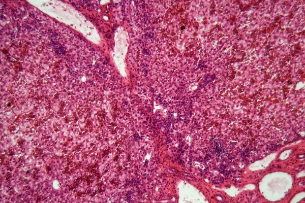 Human liver cells with cancer