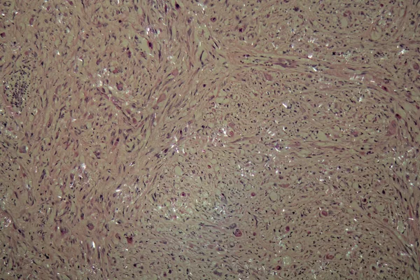 Komórki raka jądra — Zdjęcie stockowe