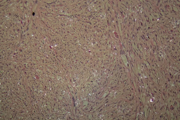 Cellule di cancro ai testicoli — Foto Stock