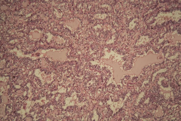 Komórek raka tarczycy — Zdjęcie stockowe