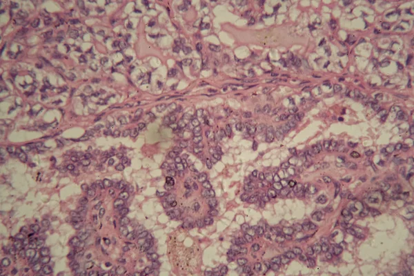 Células de la glándula tiroides con cáncer — Foto de Stock