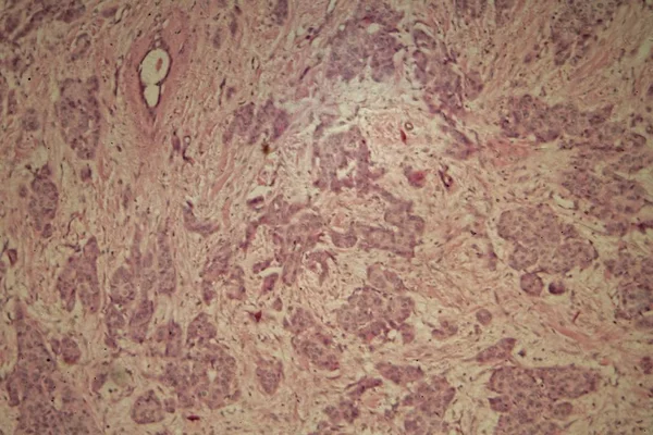 Raka piersi pod mikroskopem — Zdjęcie stockowe