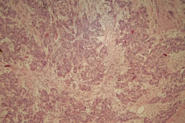 Рак груди под микроскопом — стоковое фото
