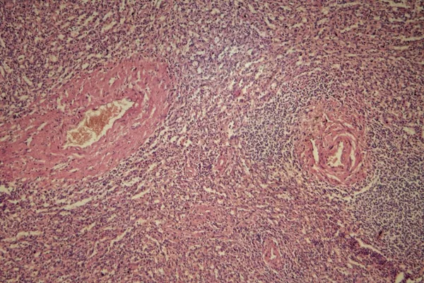 Ludzkiej śledzionie z przewlekłą białaczką szpikową — Zdjęcie stockowe
