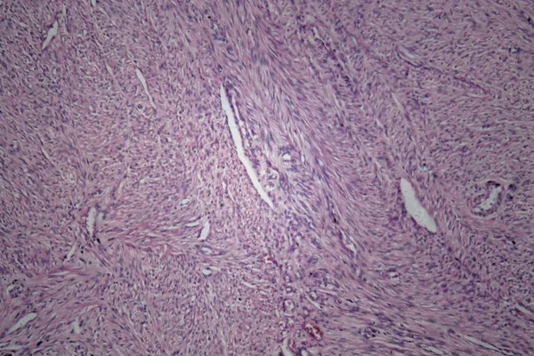 Células de tecido uterino humano com células tumorais inofensivas — Fotografia de Stock