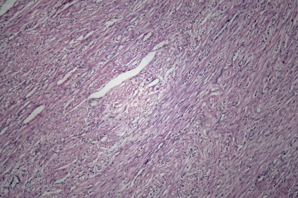Células del tejido uterino humano con células tumorales inofensivas — Foto de Stock
