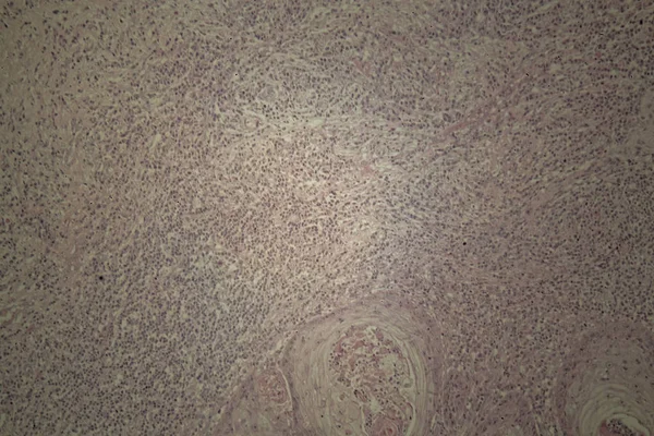 Pelle umana con carcinoma a cellule squamose — Foto Stock