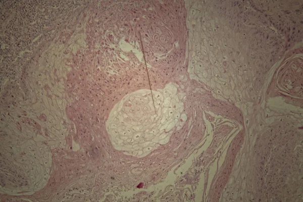 Piel humana con carcinoma de células escamosas —  Fotos de Stock