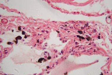 Mikroskop altında toz ve kömür parçacıkları olan insan akciğer dokusu. 