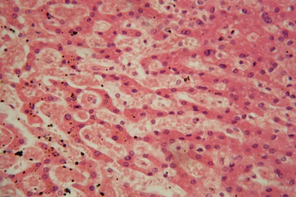 Ludzkie komórki wątroby z gruźlicą pod mikroskopem. — Zdjęcie stockowe