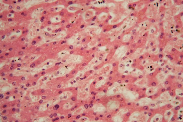 Células hepáticas humanas com tuberculose ao microscópio . — Fotografia de Stock