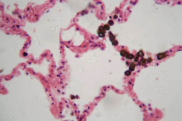 Tecido pulmonar humano com poeira e partículas de carvão ao microscópio . — Fotografia de Stock