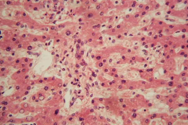 Клетки печени человека с туберкулезом под микроскопом . — стоковое фото