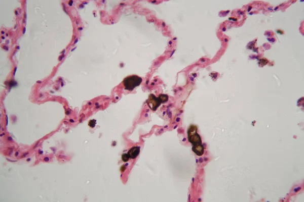 Tessuto polmonare umano con polvere e particelle di carbone al microscopio . — Foto Stock