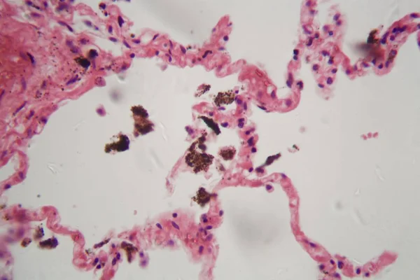 Tessuto polmonare umano con polvere e particelle di carbone al microscopio . — Foto Stock