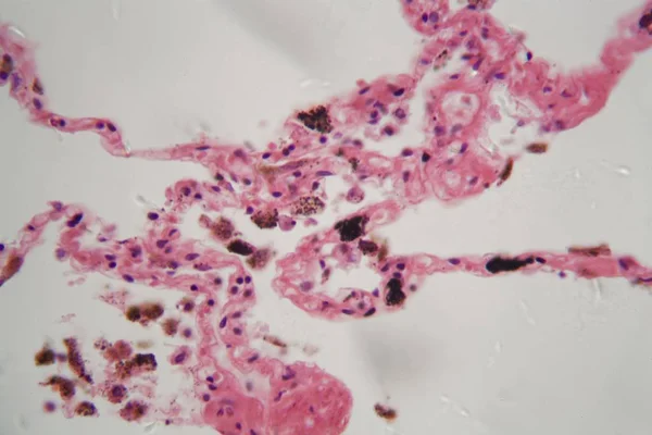 显微镜下带有灰尘和煤粉的人类肺组织. — 图库照片
