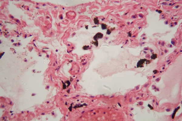 Tecido pulmonar humano com poeira e partículas de carvão ao microscópio . — Fotografia de Stock