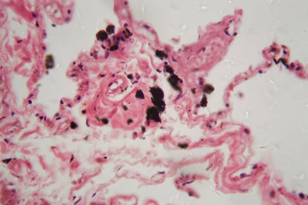 Ludzka tkanka płuc z pyłem i cząstkami węgla pod mikroskopem. — Zdjęcie stockowe