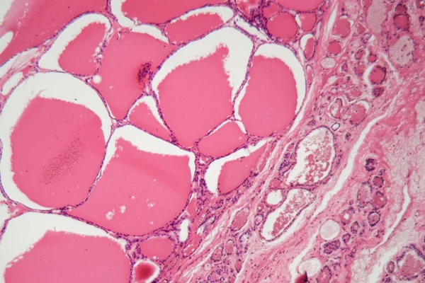 Cellules d'une glande thyroïde humaine avec gonflement au microscope . — Photo