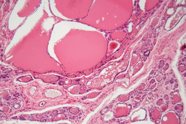 Buňky lidské štítné žlázy s otoky pod mikroskopem. — Stock fotografie