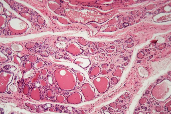 Buňky lidské štítné žlázy s otoky pod mikroskopem. — Stock fotografie