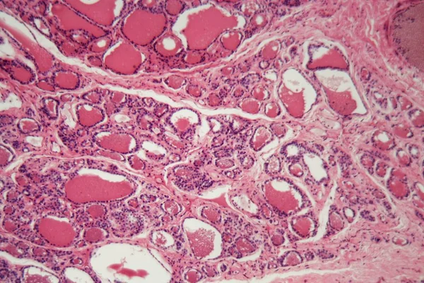 Zellen einer menschlichen Schilddrüse mit Schwellungen unter dem Mikroskop. — Stockfoto