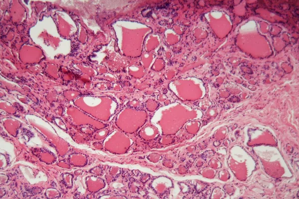 Cellules d'une glande thyroïde humaine avec gonflement au microscope . — Photo