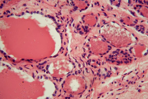 Cells of a human thyroid gland with swelling under a microscope.