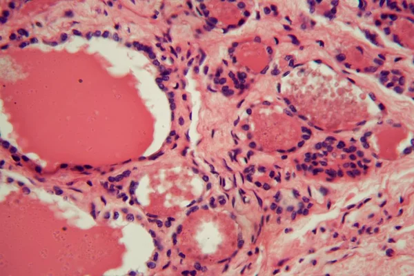 현미경으로 부어오르는 인간 갑상선 세포. — 스톡 사진