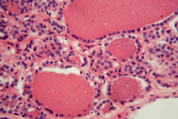 Cells of a human thyroid gland with swelling under a microscope.