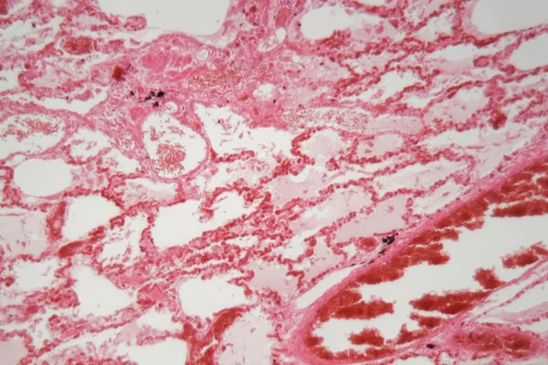 显微镜下由流感（病毒性肺炎）引起肺炎的肺组织. — 图库照片