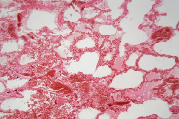 Легочная ткань с пневмонией, вызванной гриппом (вирусная пневмония) под микроскопом . — стоковое фото