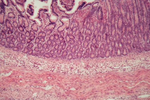 Фотография в микроскопе толстой кишки с воспалением (колит ). — стоковое фото