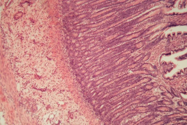 Zdjęcie mikroskopowe odcinka jelita grubego z zapaleniem (zapalenie jelita grubego). — Zdjęcie stockowe