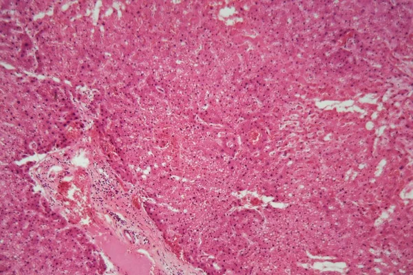 Tejido hepático con amiloidosis bajo un microscopio . —  Fotos de Stock