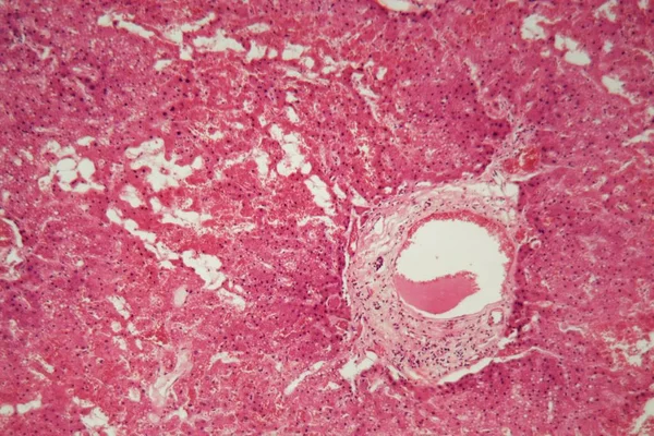Tissu hépatique avec amylose au microscope . — Photo