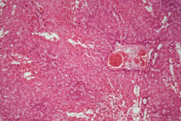 현미경으로 아밀로 이 도시스를 갖고 있는 간 조직. — 스톡 사진