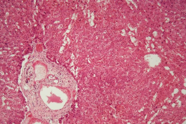Levervävnad med amyloidos i mikroskop. — Stockfoto