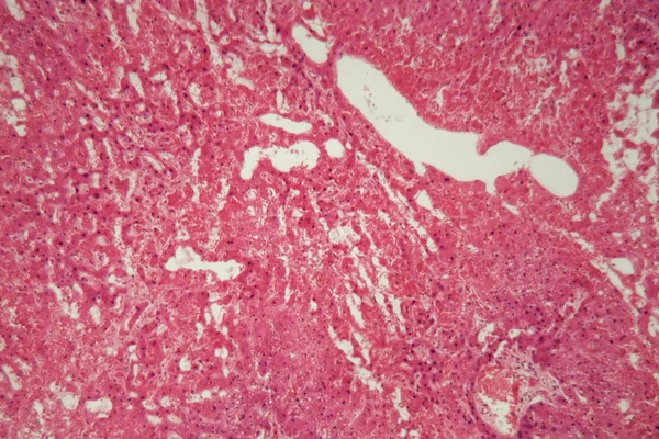 Ткани печени с амилоидозом под микроскопом . — стоковое фото
