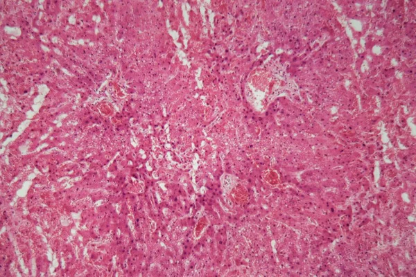 현미경으로 아밀로 이 도시스를 갖고 있는 간 조직. — 스톡 사진